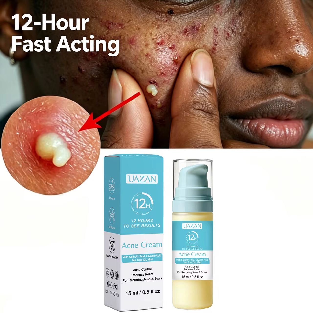 ACNE CREAM